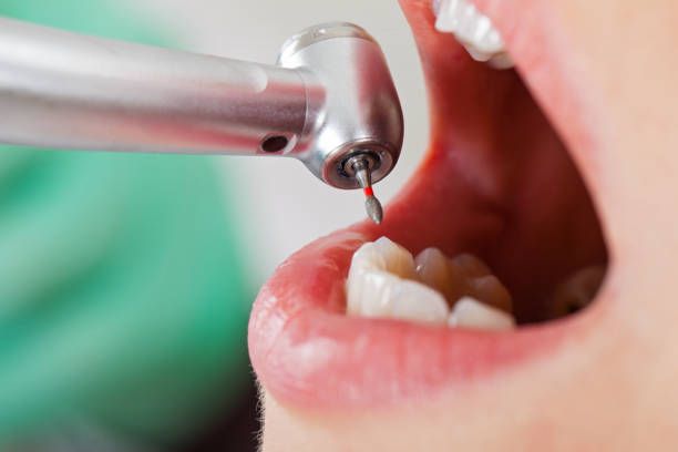 Best Emergency Treatment for Dental Infections or Abscesses in Mackinaw, IL